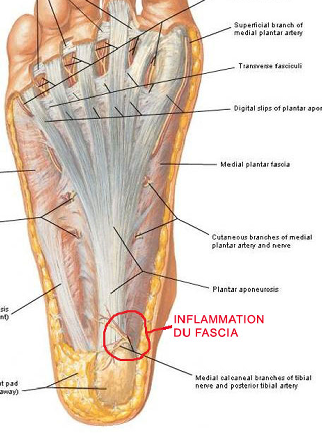 Fasciite plantaire