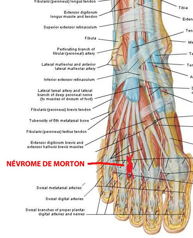 Névrome de Morton