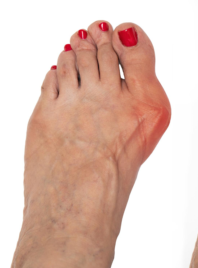 Oignon aux pieds (Hallux valgus)