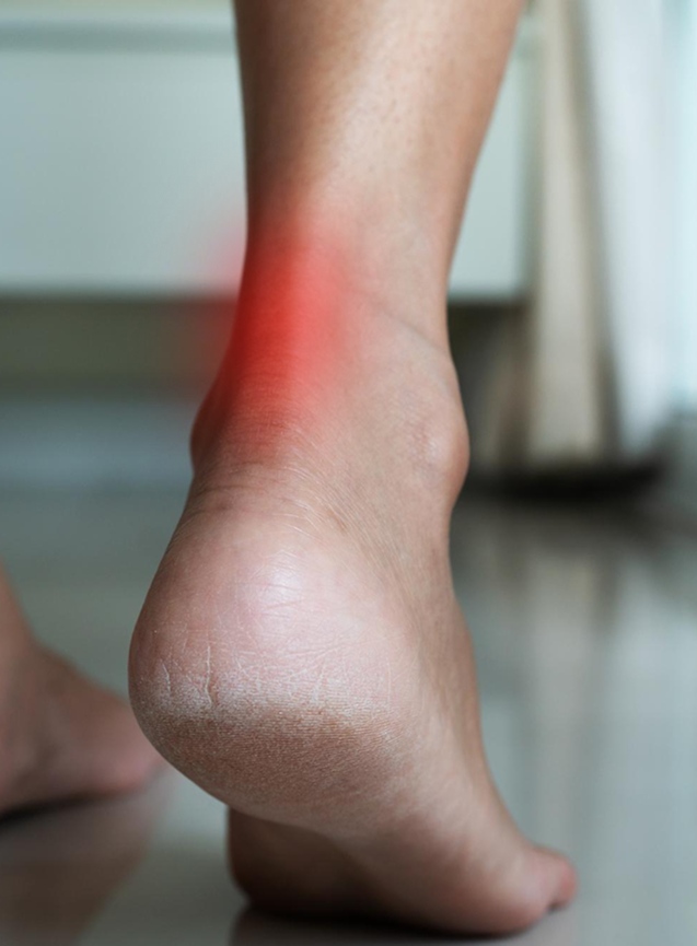 Tendinite d’Achile