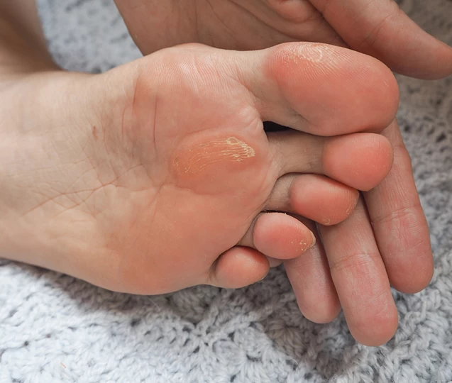 Affection liée aux cors aux pieds