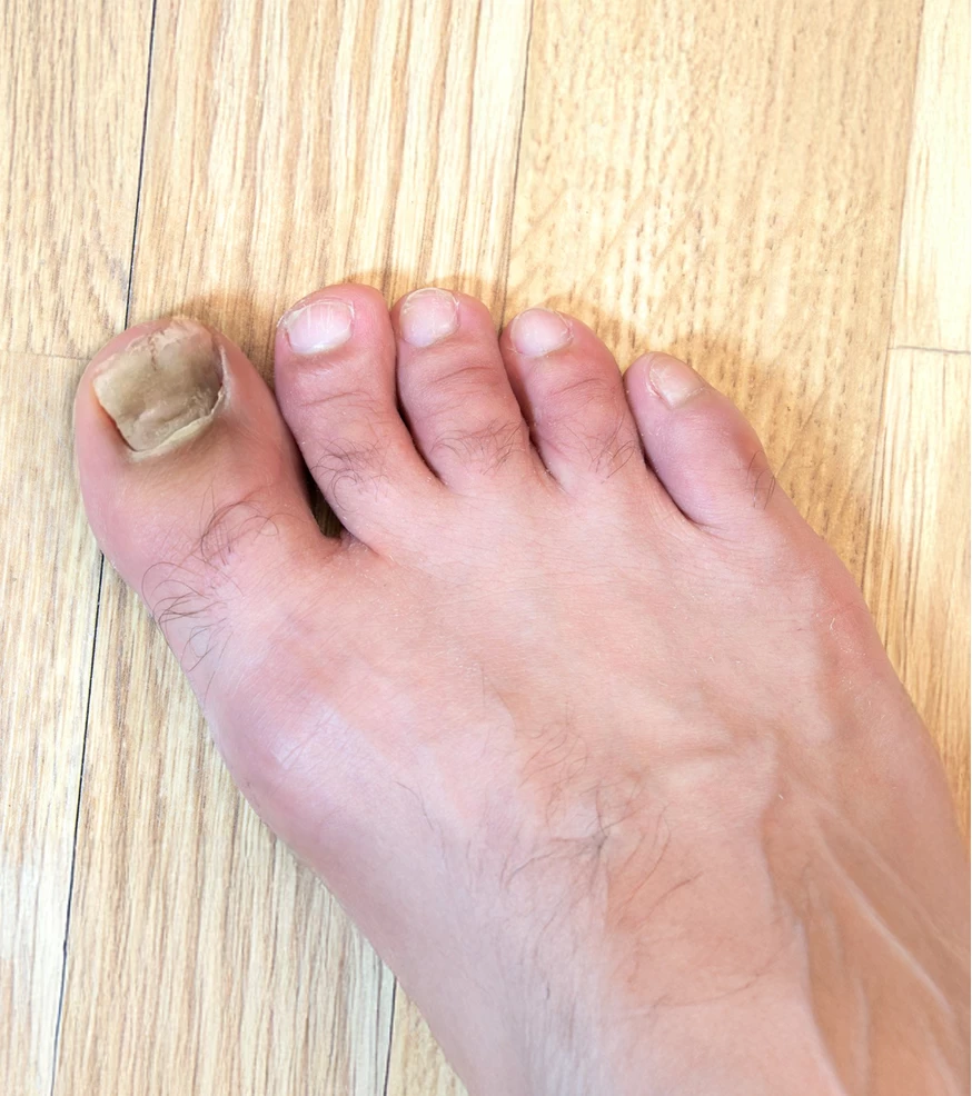 Ongle-épais
