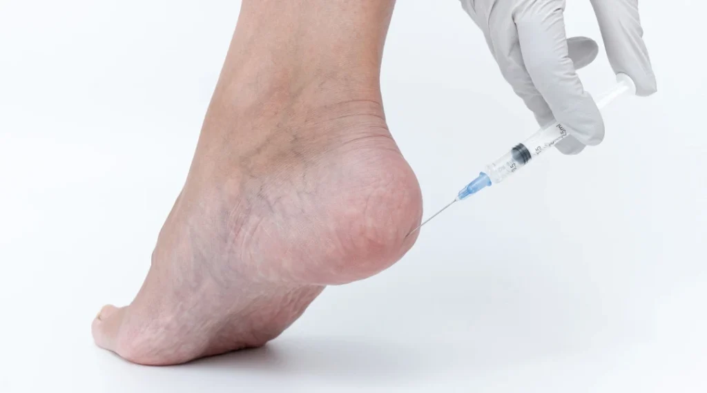 injection-douleur-talon-une-solution-ciblee